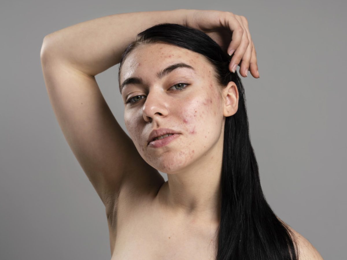 Μπορεί πράγματι η ακμή να αντιμετωπιστεί με συσκευή υψηλής συχνότητας;